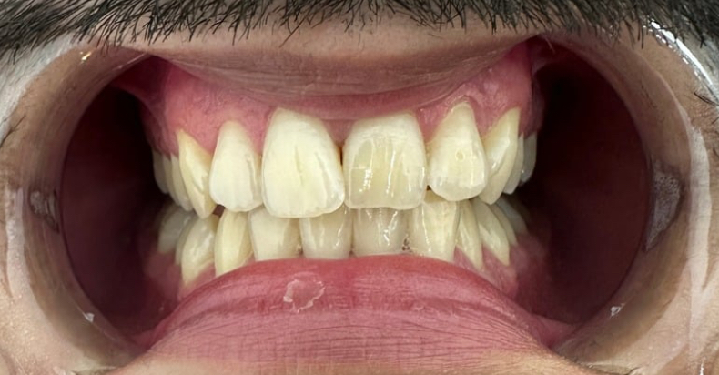 Nahaufnahme eines geöffneten Mundes mit sichtbaren natürlichen Zahnverfärbungen vor einer Zahnaufhellung