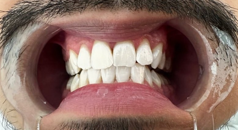 Nahaufnahme desselben geöffneten Mundes mit sichtbar aufgehellten Zähnen nach einer Zahnaufhellung